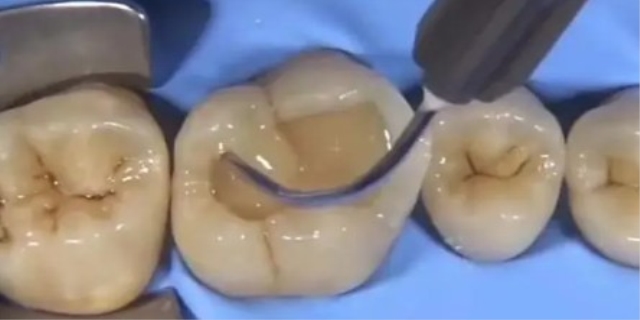 千万不要去补牙洞的原因是什么