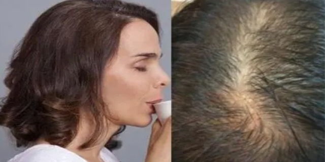 女性严重脱发是什么病先兆
