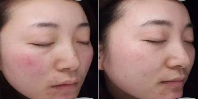 光子嫩肤4次后皮肤越来越差怎么回事